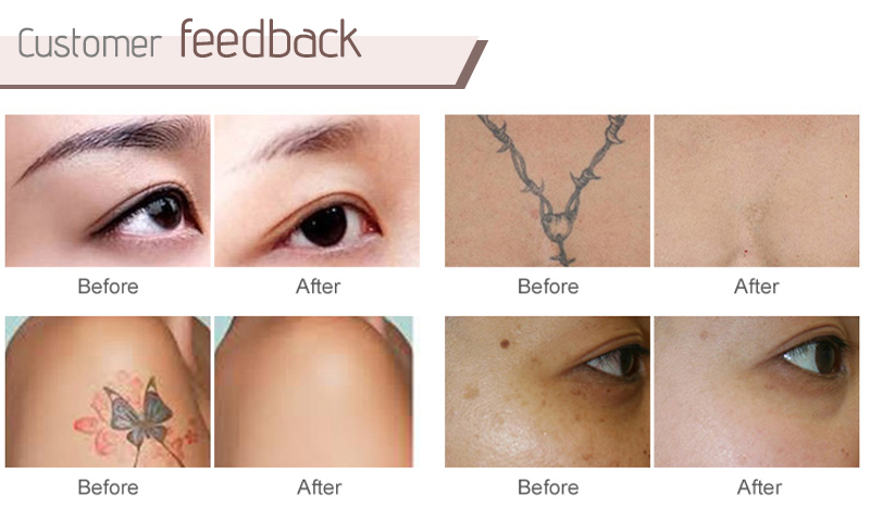 color tattoo removal