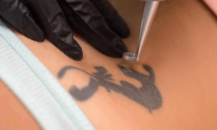 Highly Effective Tattoo Removal: Nanosecond Technology Vs. Picosecond Technology