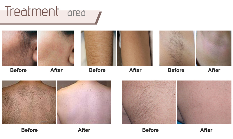 best hair removal machine