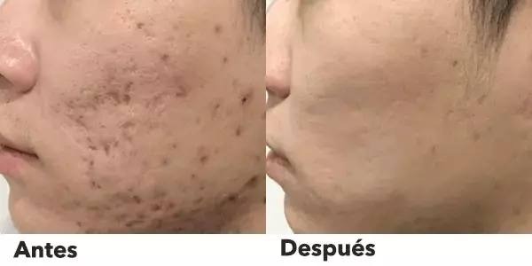 tattoo removal laser