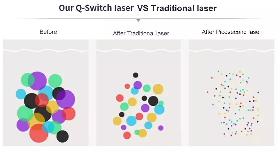 tattoo removal machine