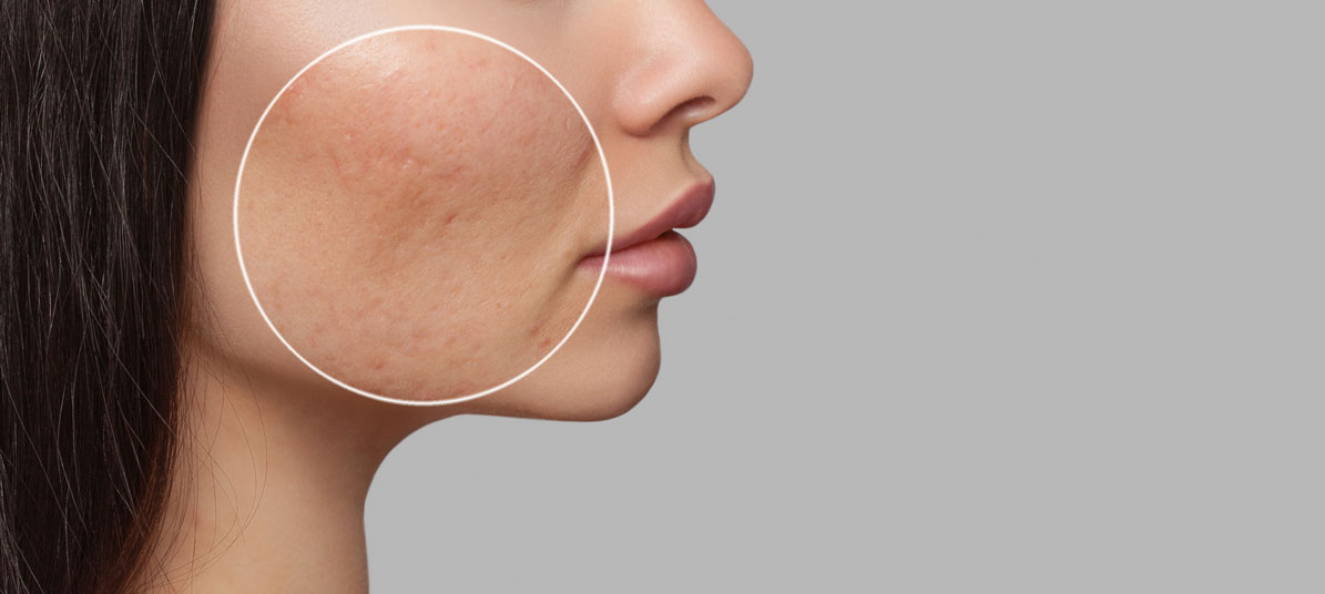 Are You Truly A Suitable Candidate for Fractional CO2 Laser Treatment?