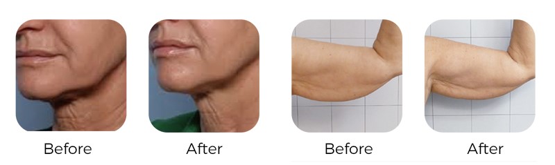 Cool Microwave Body Sculpt