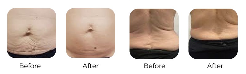 Microwave body contouring treatment before and after