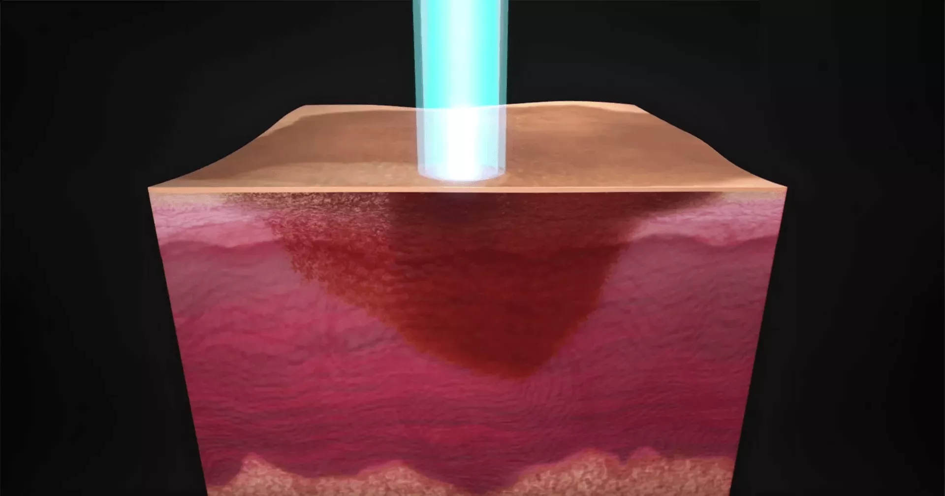 nd yag laser tattoo removal machine