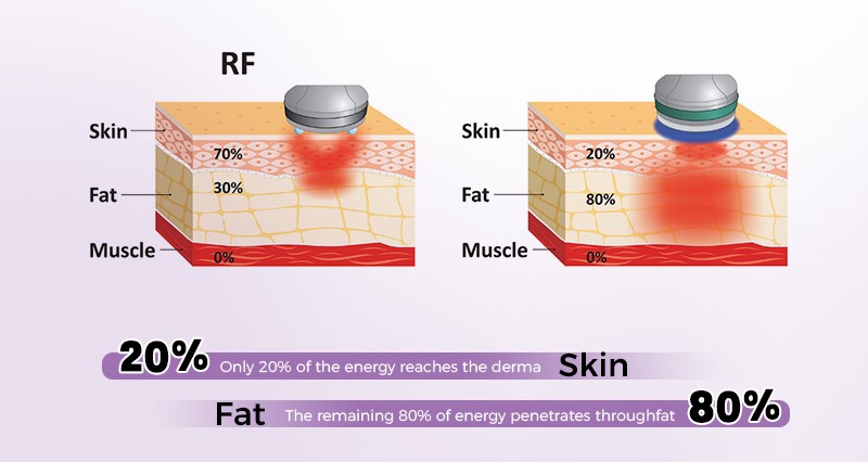 2.45GHz Pro Microwave body contouring machine