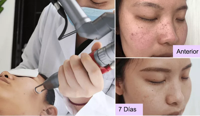 laser tattoo removal machine