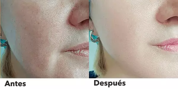 laser tattoo removal machine