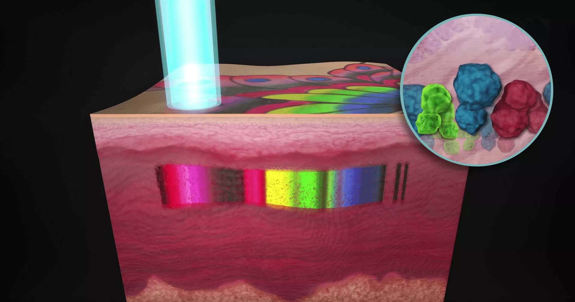 laser tattoo removal machine