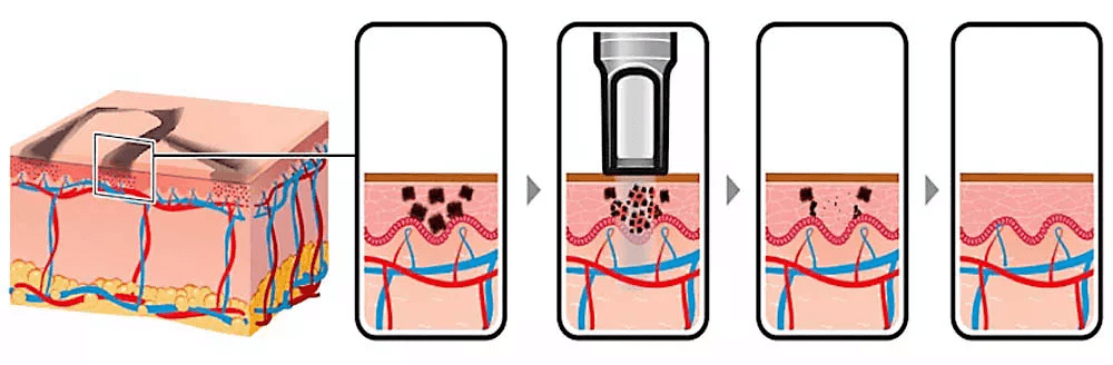 pico laser tattoo removal