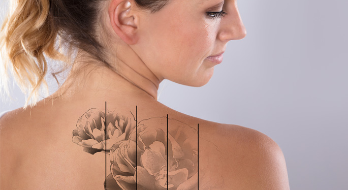 Do You Really Understand Picosecond Laser Technology?