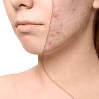 Acne Repair